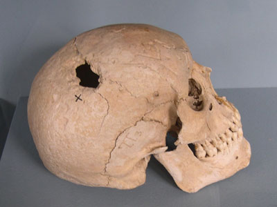 Trepanation